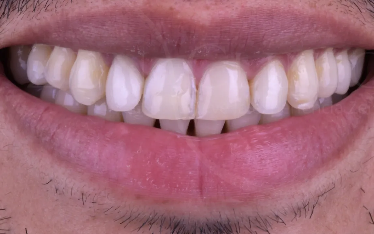 Antes: caso 2, diseño de sonrisa con carillas cerámicas