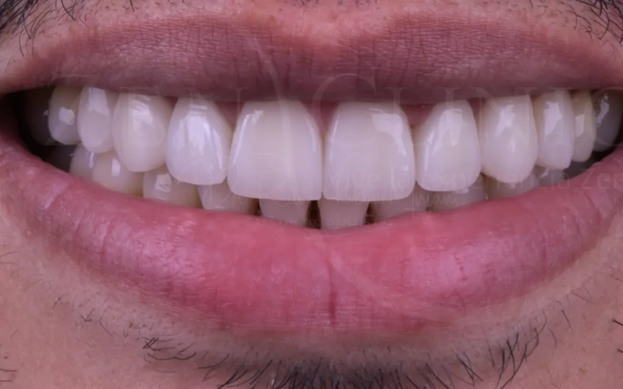 Después: caso 2, diseño de sonrisa con carillas cerámicas