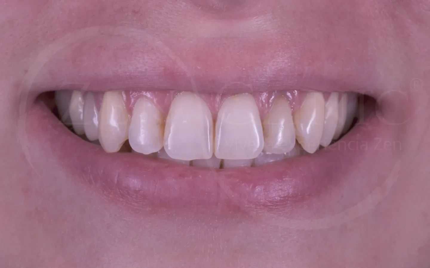 Antes: caso 4, diseño de sonrisa con carillas cerámicas