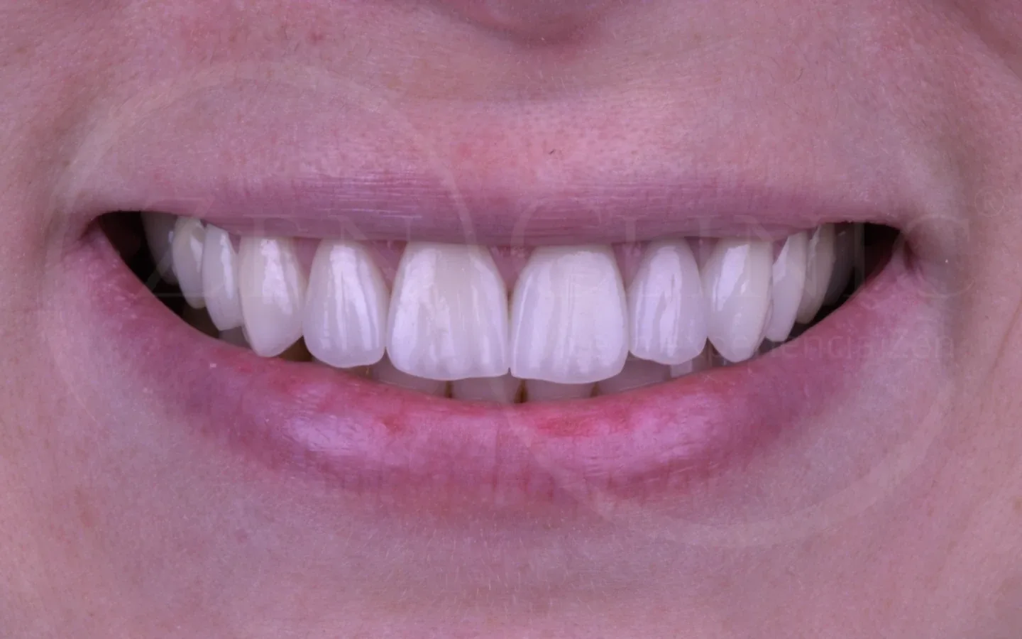 Después: caso 4, diseño de sonrisa con carillas cerámicas