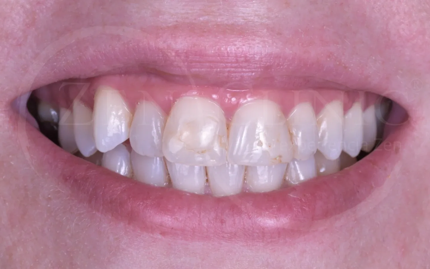 Antes: caso 5, diseño de sonrisa con carillas cerámicas