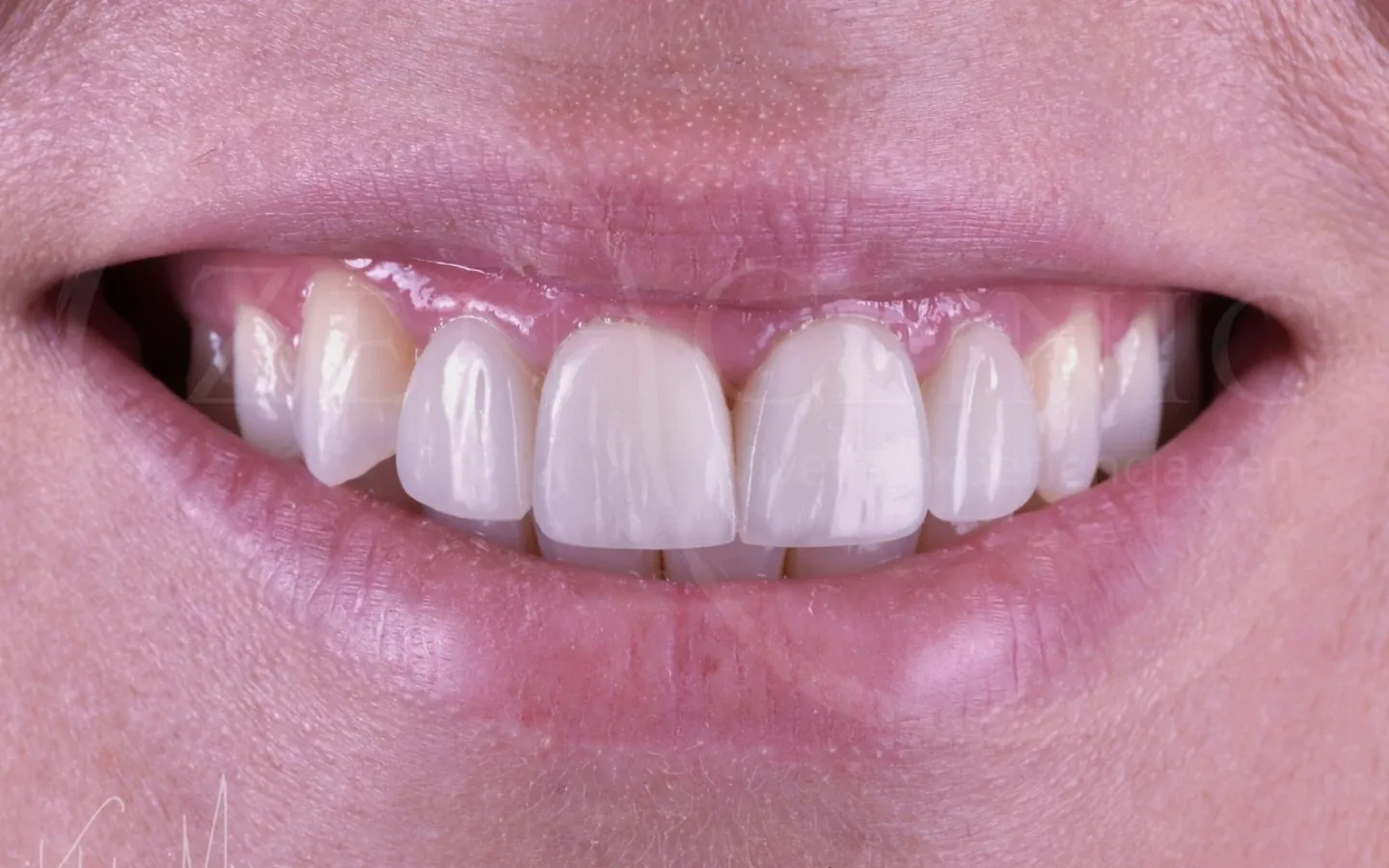 Después: caso 5, diseño de sonrisa con carillas cerámicas