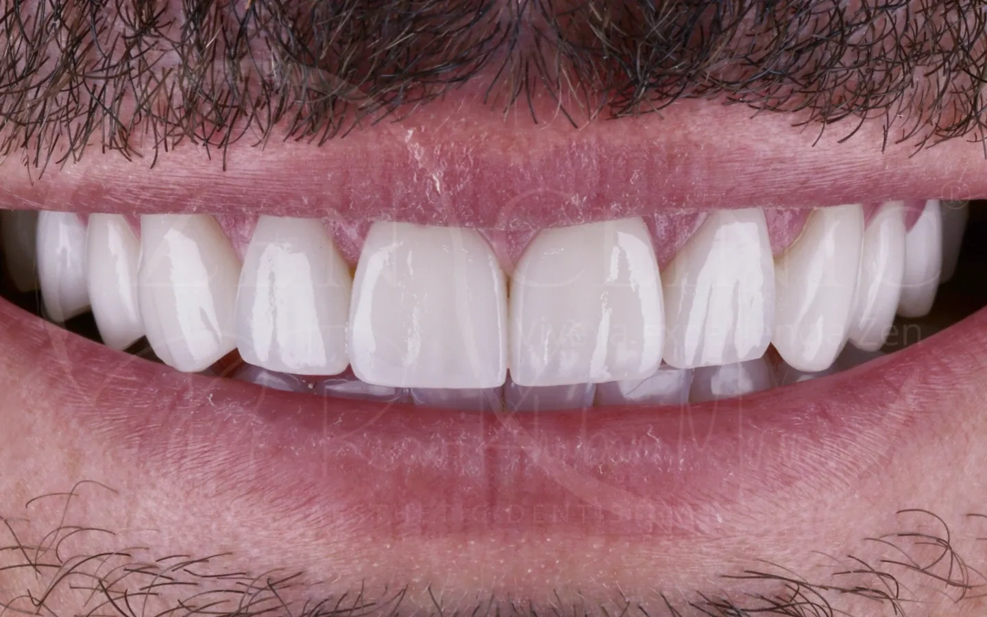 Después: caso 6, diseño de sonrisa con carillas cerámicas