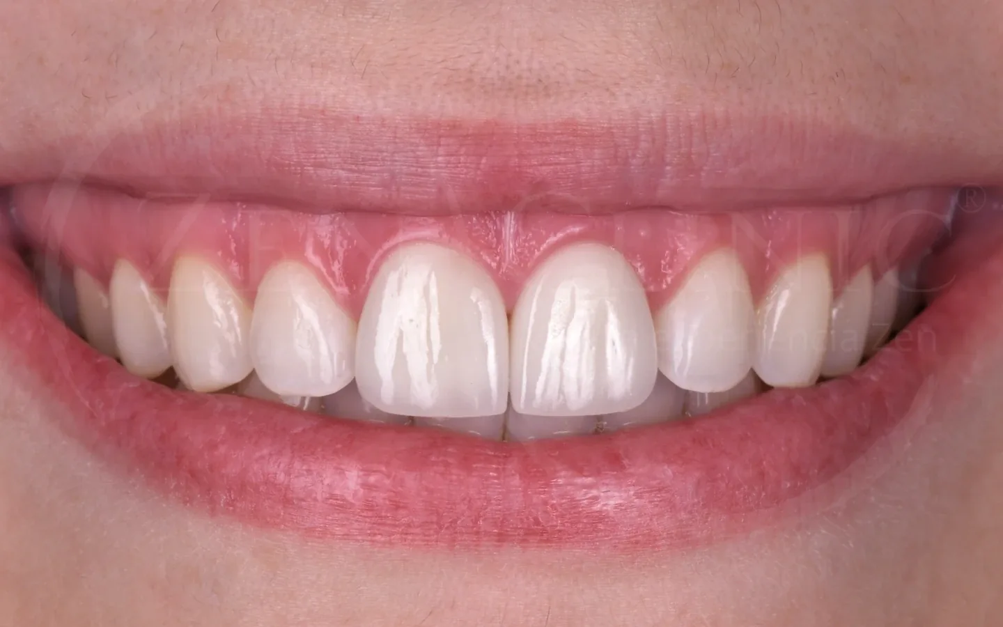 Después: caso 8, diseño de sonrisa con carillas cerámicas