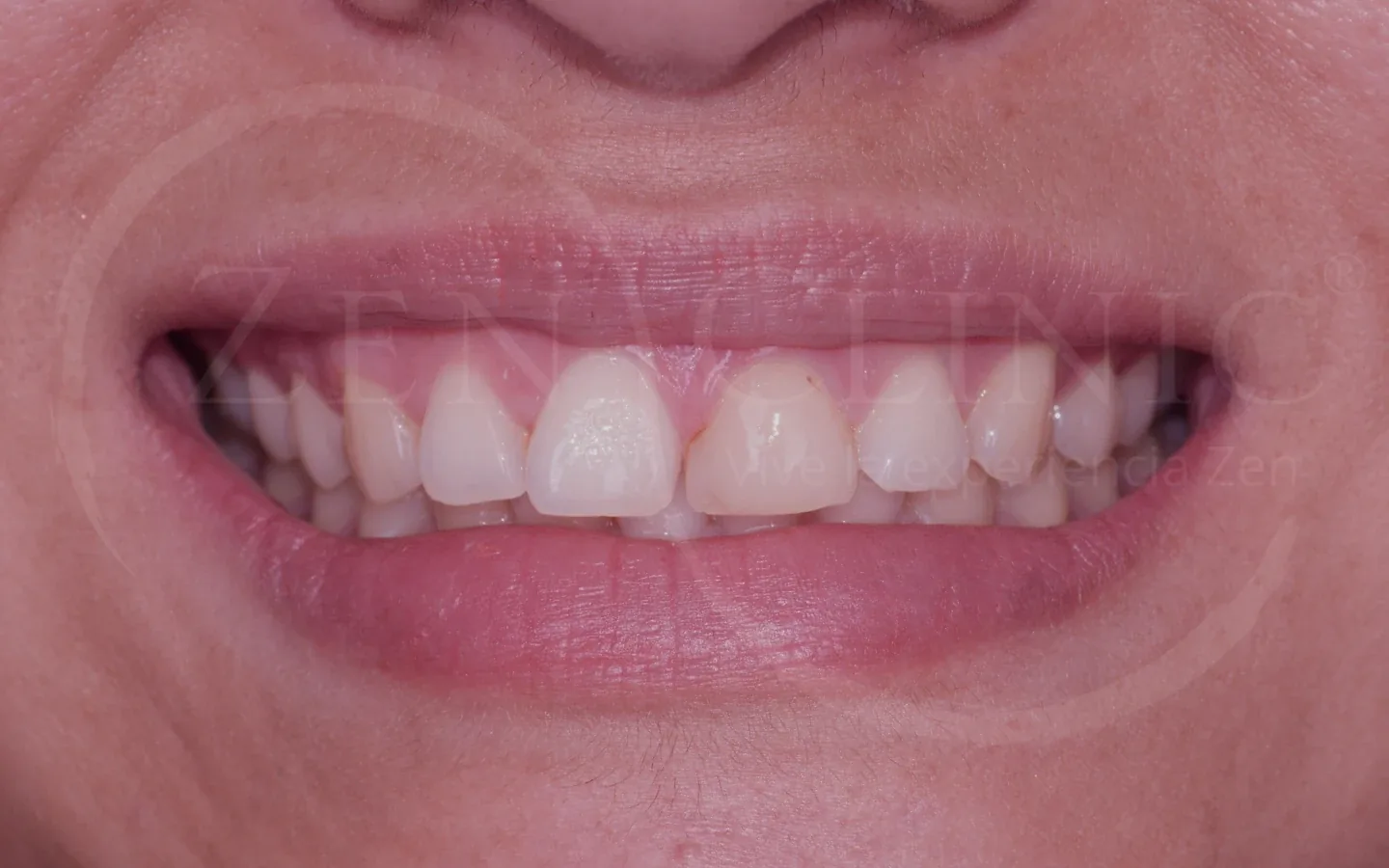 Antes: caso 9, diseño de sonrisa con carillas cerámicas